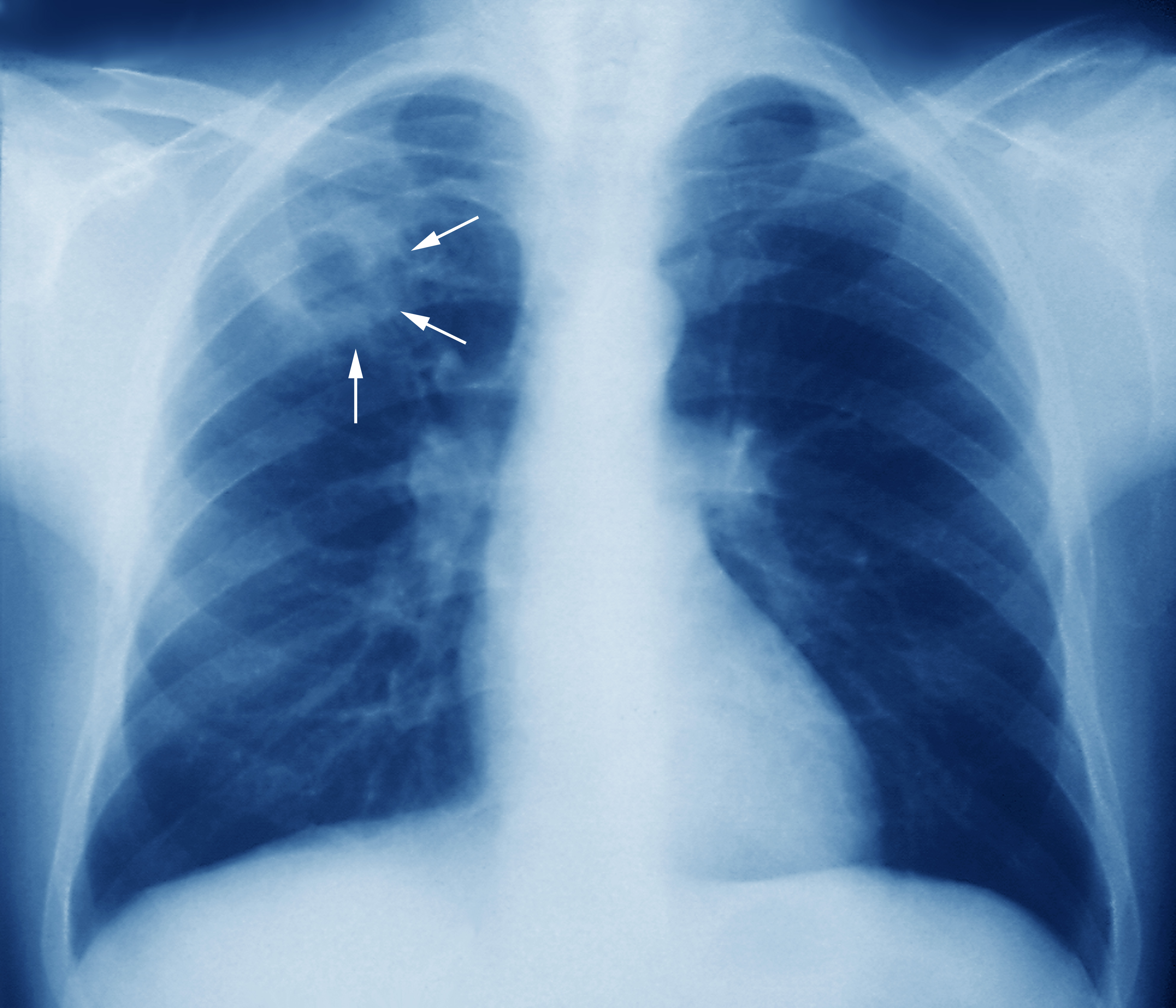 http://medthai.net/wp-content/uploads/2020/12/m2700245-tuberculosis-chest-x-ray-science-photo-library-high.jpg