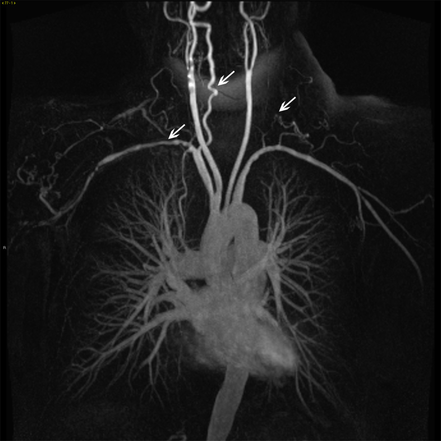 https://www.msdmanuals.com/-/media/manual/professional/images/19a-images-of-aorta-in-takayasu-arteritis-ctisus.jpg?thn=0&sc_lang=th