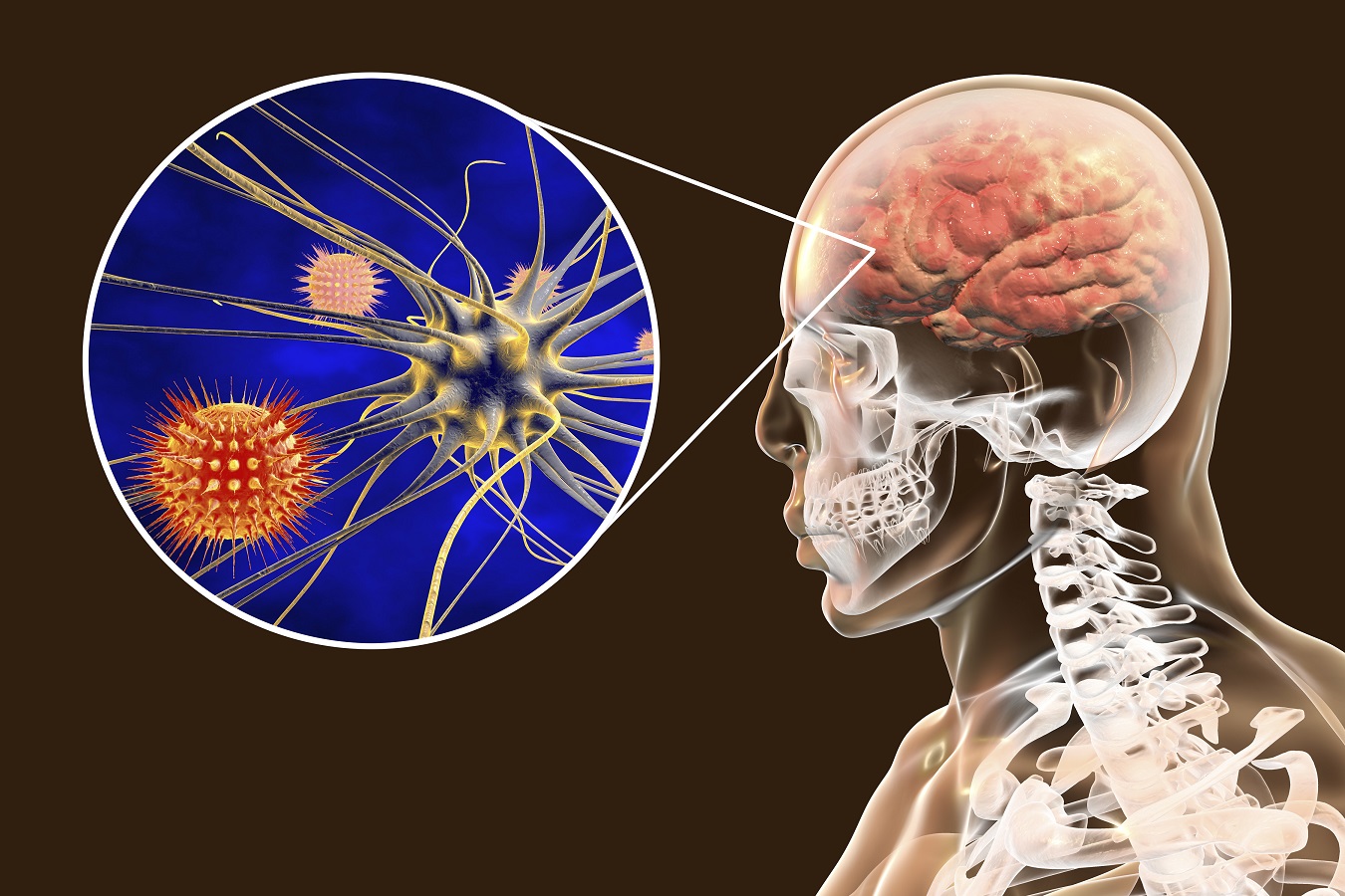 เยื่อหุ้มสมองอักเสบจากเชื้อแบคทีเรีย: อาการและการรักษา