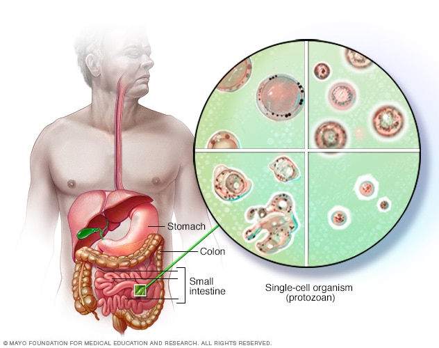 Blastocystis hominis - สาเหตุอาการและการรักษา